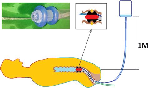 Irrigation of fecal diversion device after primary surgery | Download ...