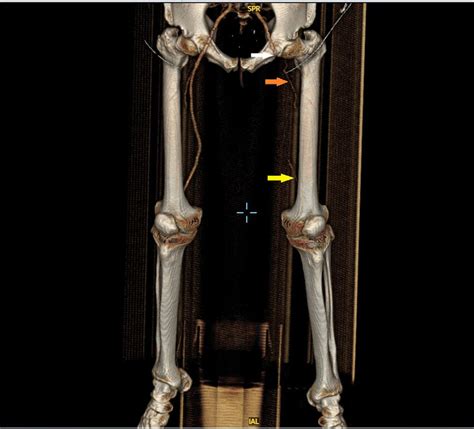 Three Dimensional Reconstruction Of Ct Angiogram Lower Limbs Showing