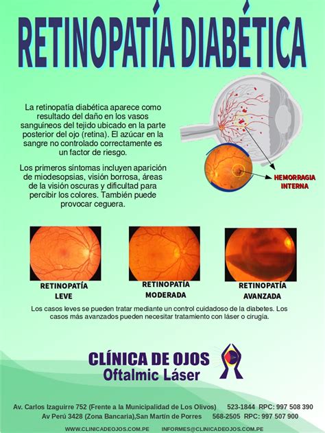 Clínica de Ojos Oftalmic Láser: RETINOPATÍA DIABÉTICA