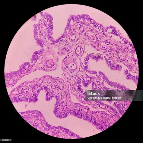 Mature Cystic Teratoma Ovarian Cyst Biopsy Show Cyst Wall Of Skin And ...