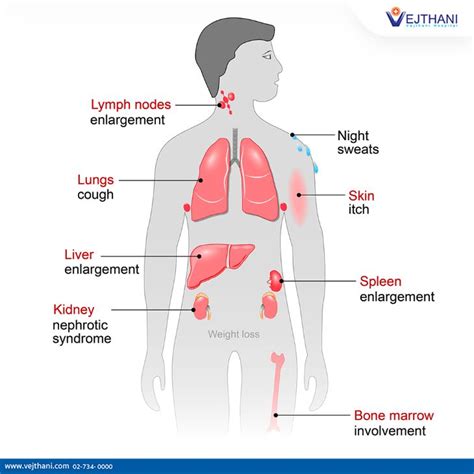 Lymphoma Treatment in Thailand | Vejthani Hospital