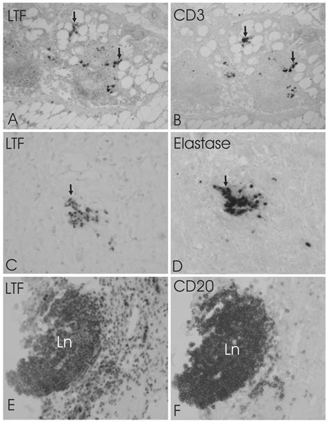 Co Localization Of Lactoferrin Ltf With Neutrophils And T And B