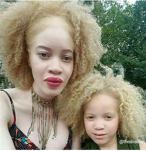 Mom Albino Daughter Mixed African Beauty Beautiful Black Women