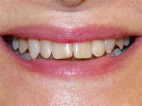 Un Sorriso Da Sposi Denti Perfetti Per Il Tuo Matrimonio Antonella