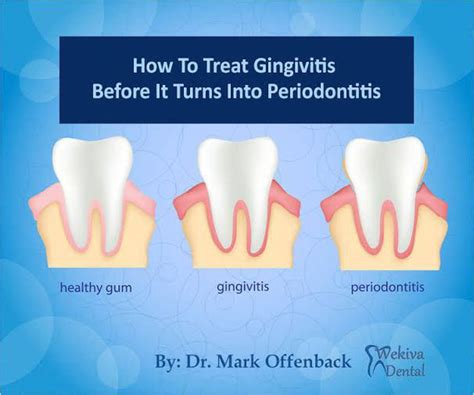 Gingivitis treatment - MEDizzy