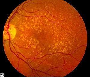 Degeneração macular relacionada à idade (DMRI): principais dúvidas - Awor