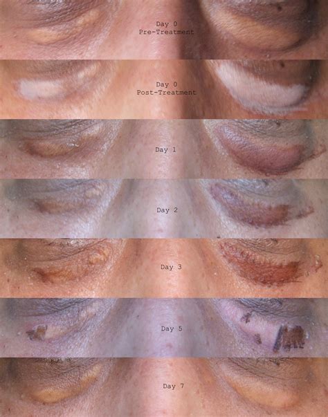 Xanthelasma Treatment: Xanthelasma Treatment - My Experience of DIY ...