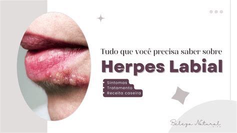 Herpes Labial O Que Você Precisa Saber sobre o HSV 1 Beleza Natural