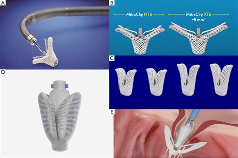 Transcatheter Mitral Valve Repair