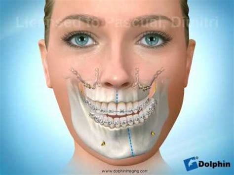 Chirurgie pour Asymétrie faciale Maxillo mandibulaire YouTube