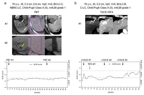 Current Oncology Free Full Text Longer Survival And Preserved Liver