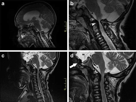 Involvement Of The Craniocervical Junction Sagittal T2 Weighted Fast Download Scientific