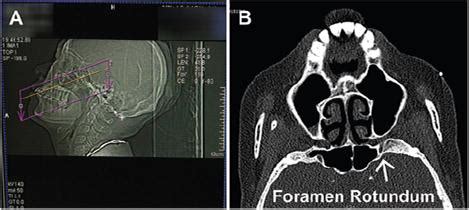 Foramen Rotundum Ct Coronal