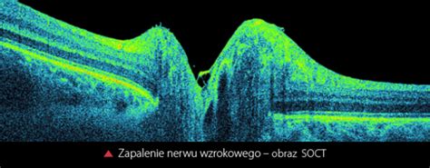 Zapalenie Nerwu Wzrokowego Gabinet Okulistyczny