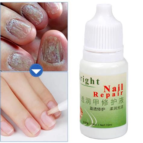 Убивает грибок ногтей Крем для лечения Onychomycosis Paronychia анти ...