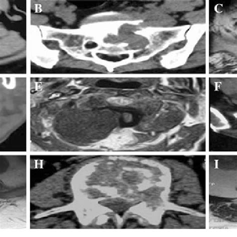 Computed Tomographic And Magnetic Resonance Images Of Spinal Malignant