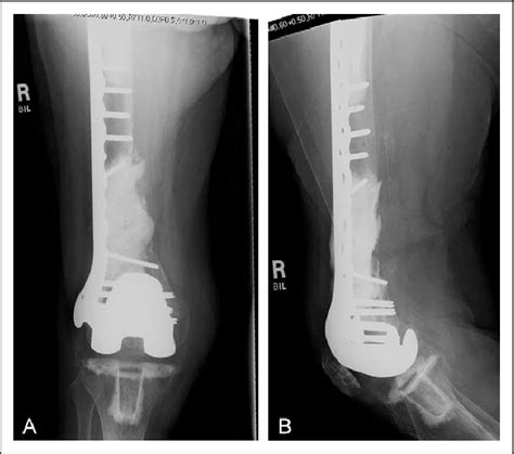 Final Follow Up Radiographs At 18 Months Download Scientific Diagram