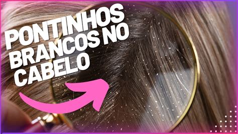 Pontinhos Brancos No Cabelo O Que Pode Ser Youtube