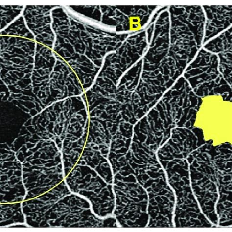 Optical Coherence Tomography Angiography OCTA Parameters Evaluated In