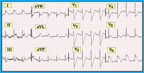 ECG Interpretation: ECG Blog #131 (Acute STEMI – Acute Occlusion of LAD ...