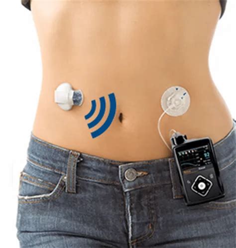 Medtronic Minimed 640g Insulin Pump For Clinical Purpose At ₹ 550000