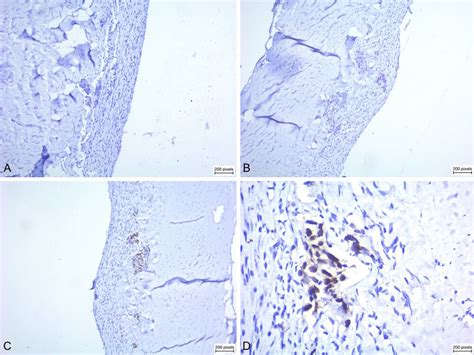 Rectal Dural Metastasis Masquerading As Chronic Subdural Hematoma