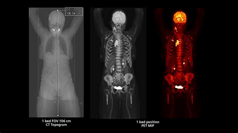 Biograph Vision Quadra Pet Ct Scanner Siemens Healthineers Siemens