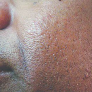 Calcinosis Cutis Face