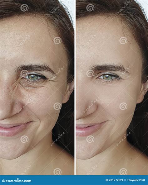 Woman Face Wrinkles Hydrating Before After Mature Treatment Stock Photo