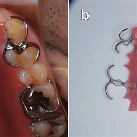 Postoperatively With Definitive Obturator A From The Occlusal Surface