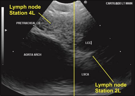 Techniques Of Linear Endobronchial Ultrasound Intechopen