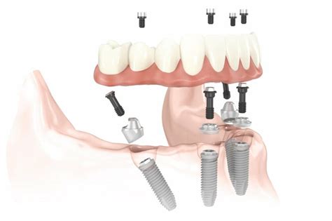 All On 4 Dental Implants Hybrid Implant Dentures Baluke Dental