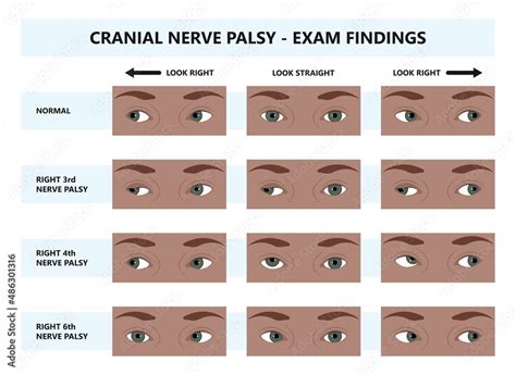 Diplopia Double Vision Test Exam Brain Nerve Dry Eye Palsy Gravis