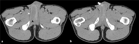 Axial Contrast Enhanced Ct Images Through The Proximal Corpora