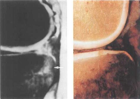 Mr Imaging Fat Saturated T2 Left Of A Bone Bruise Located Download Scientific Diagram