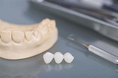 What Should You Expect After Dental Bridge Procedure?