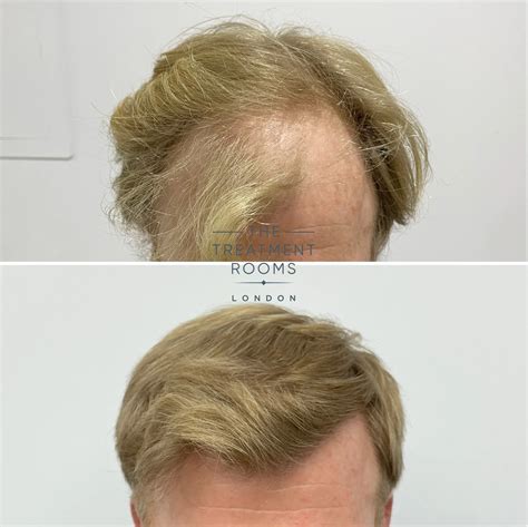 Fue Hair Transplant Result 2087 Grafts Treatment Rooms London