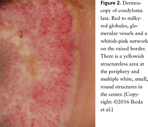 [pdf] Condylomata Lata On The Ankle An Unusual Location Semantic Scholar