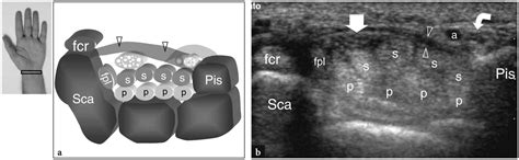 Ultrasound Of The Musculoskeletal System Chapter 10 Wrist Nysora