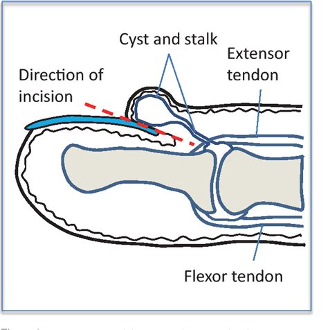 Proximal nail fold flap for digital mucous cyst excision. | Semantic ...