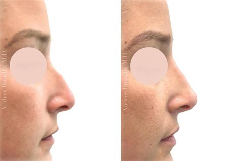 Liquid Rhinoplasty Before And After Booycomputer