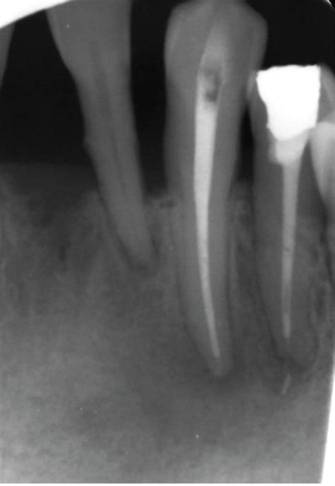 Postoperative Periapical Radiograph Showing Endodontic Treatment Of