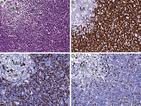 Itmig Consensus Statement On The Use Of The Who Histological