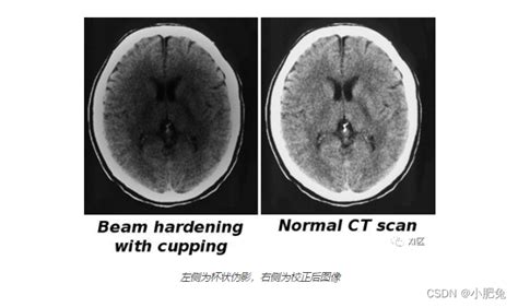 Ct伪影：根本原因与规避方法小鼠ct运动伪影 Csdn博客