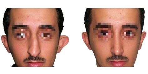 The Dorsal Hump Rhinoplasty Archive