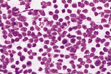 The techniques of FNA cytology | Basicmedical Key