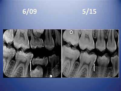 Surface Treatments Of Non Cavitated Proximal Lesions