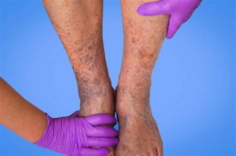 What Is Stasis Dermatitis