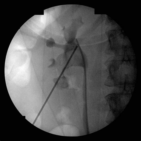 Radiopaedia Case Percutaneous Nephrolithotomy Id 48222 Study 53086
