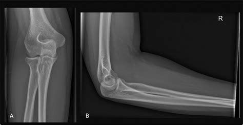 Elbow X Ray Ap